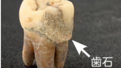 「天下の台所」の食生活―古歯石プロテオミクスが明らかにした江戸時代の大阪庶民の多様な食事内容―