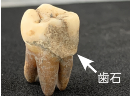 「天下の台所」の食生活―古歯石プロテオミクスが明らかにした江戸時代の大阪庶民の多様な食事内容―