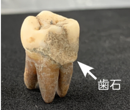 「天下の台所」の食生活―古歯石プロテオミクスが明らかにした江戸時代の大阪庶民の多様な食事内容―